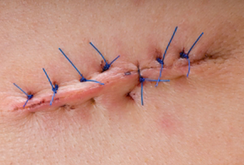 wound-stitches