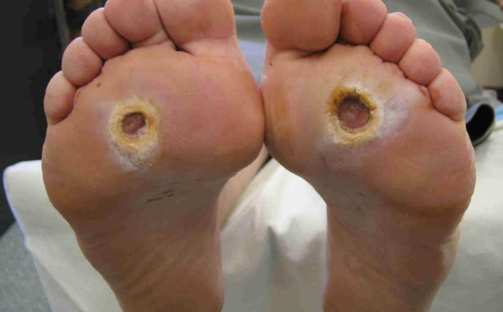 bilateral-neuropathic-foot-ulcers-1024x768