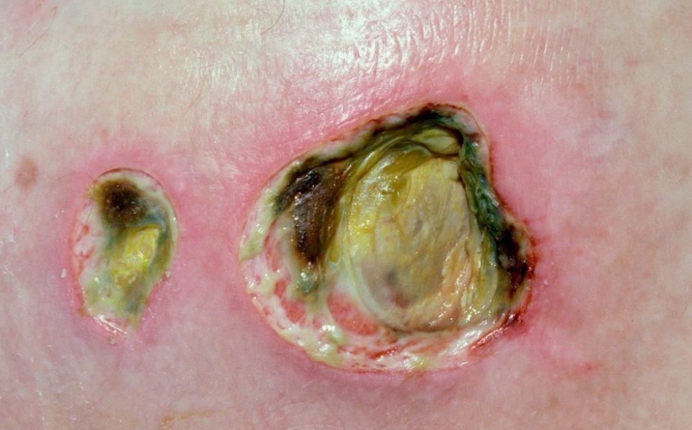 grade-4-pressure-ulcer-1024x726