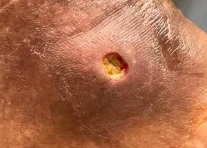 imageye___-_imgi_3_Diabetic+foot+ulcer